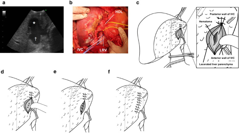 確定的修復の手順。a:術中超音波でIVC前方に液体腔を確認。b:肝十二指腸間膜と主要静脈のテーピング。c:前・後壁を貫通する肝後面IVC裂創。d:後壁の縫合。e:前壁を肝実質とともに縫合。f:肝実質を閉鎖し止血。HDL:肝十二指腸間膜、LRV:左腎静脈。