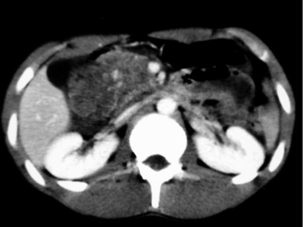 受傷後の腹部CT。十二指腸付近の後腹膜血腫を示す。