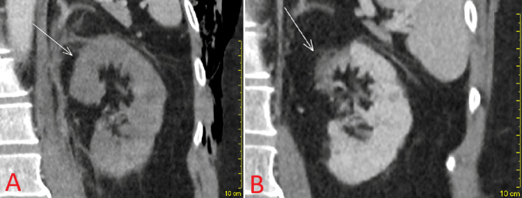 初期CT(A)と退院11か月後(B)。上極の最大皮質厚が1.7 cmから1.0 cmに減少。